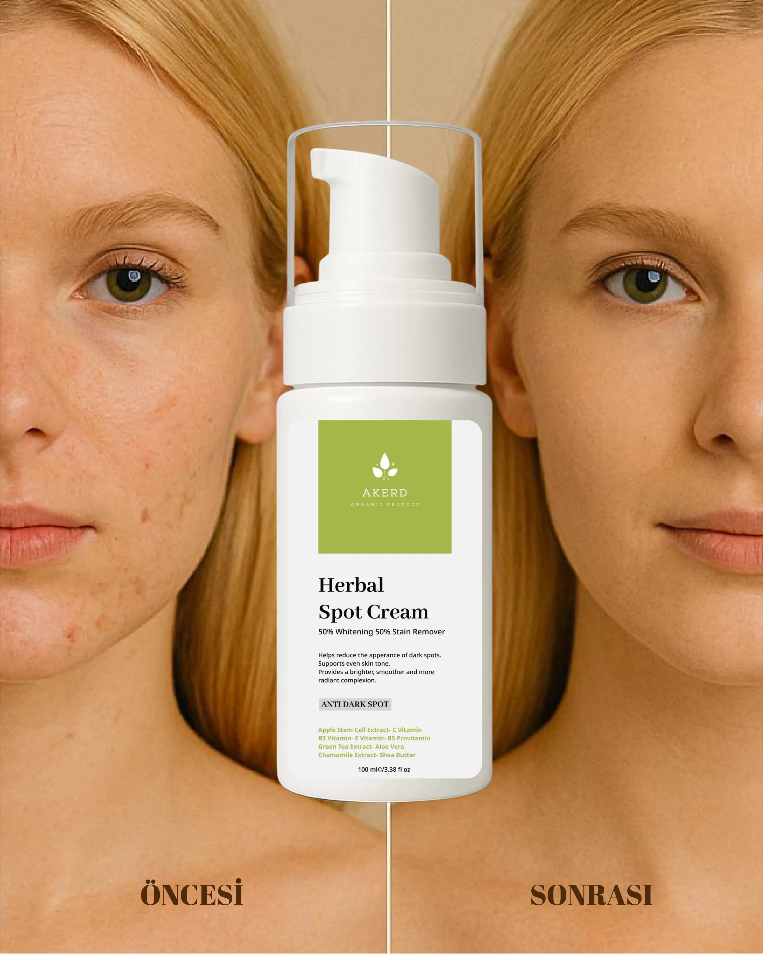 Leke Kremi - AKERD COSMETİCS LEKE KREMİ Beyazlatıcı Kararma